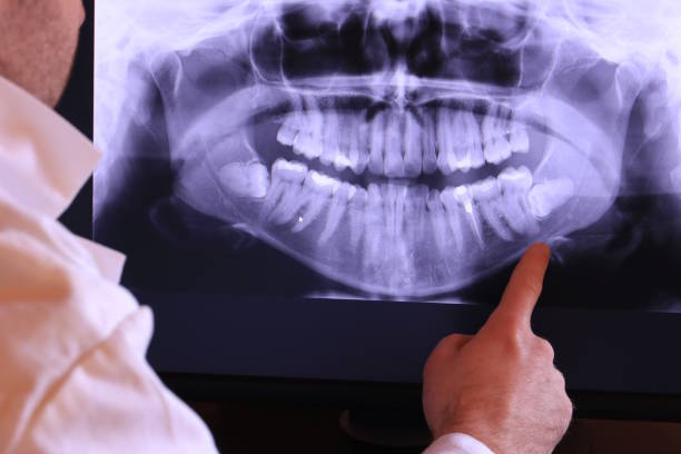 Best Emergency Dentist for Lost Fillings or Crowns in East Dubuque, IL